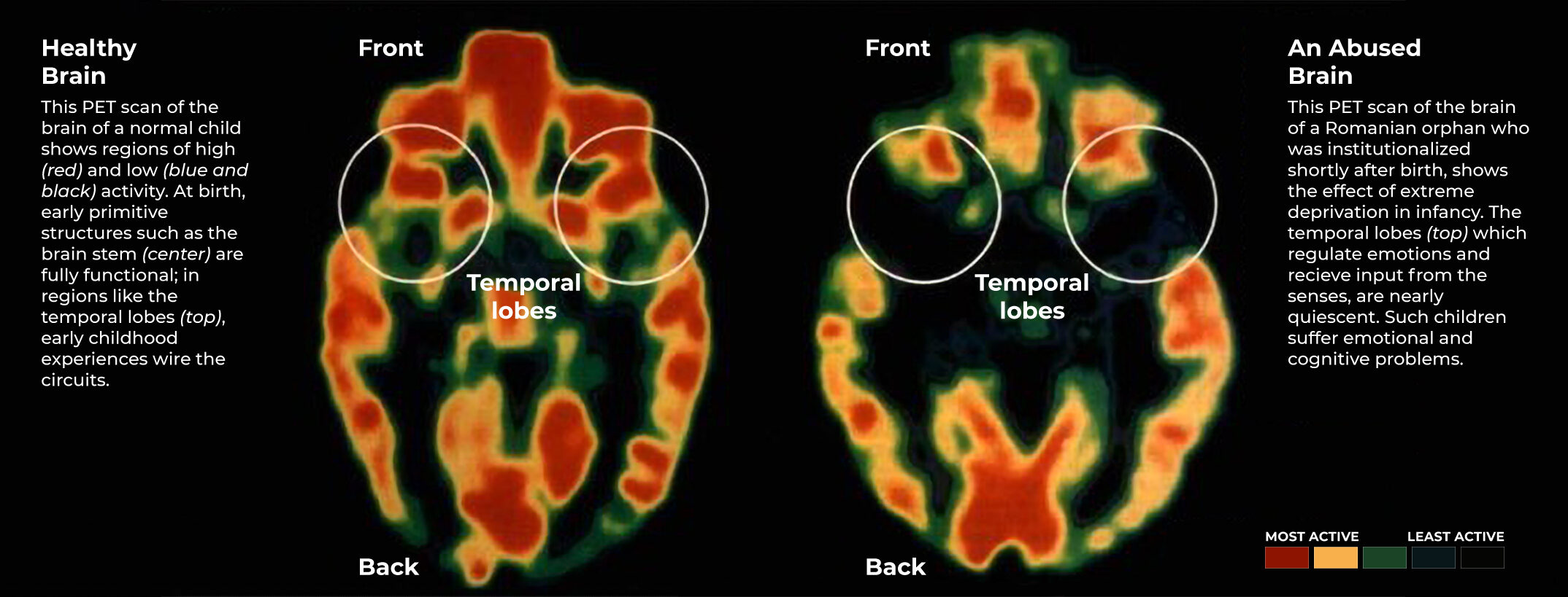PET Scan Comparison of a healthy brain vs. an abused brain. (Chugani M.D, H. (n.d.) )